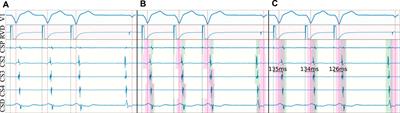 Delineation of intracavitary electrograms for the automatic quantification of decrement-evoked potentials in the coronary sinus with deep-learning techniques